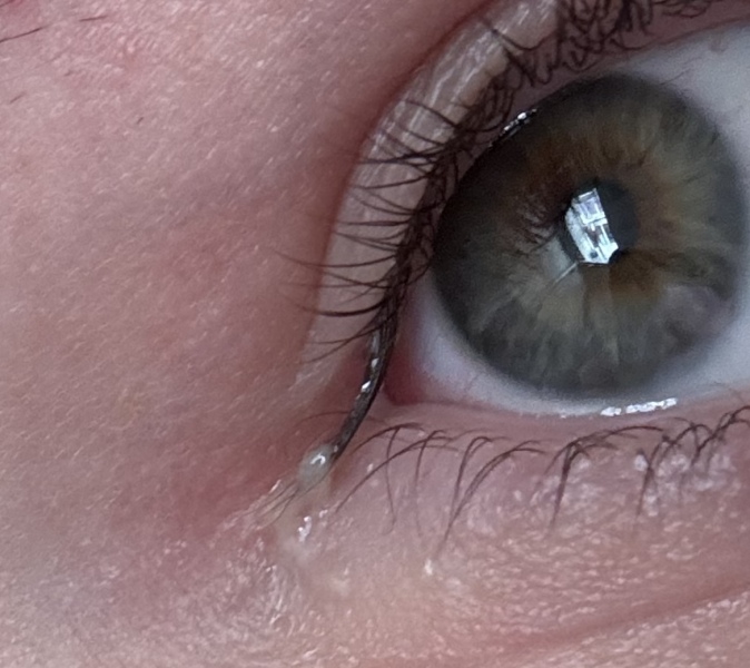 To ask if this looks like the start of conjunctivitis?