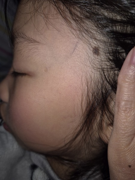 Worried about child's mole