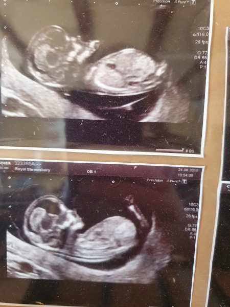 Babies head in scan