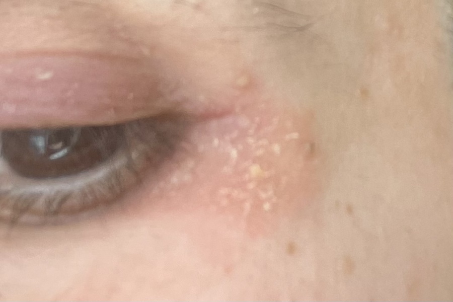 Psoriasis or eczema