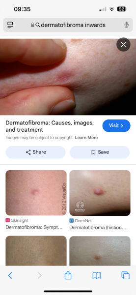 Is this melanoma?? Handhold needed