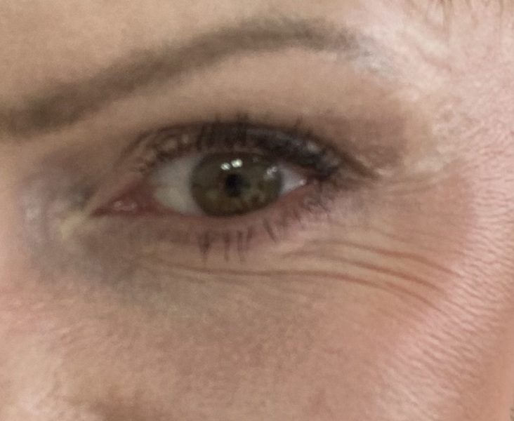 Would Botox help this?