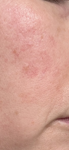 Anyone know what this red patch on my cheek could be?