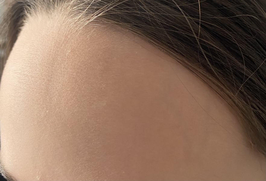 AIBU to be worried about this indent in my child’s forehead?
