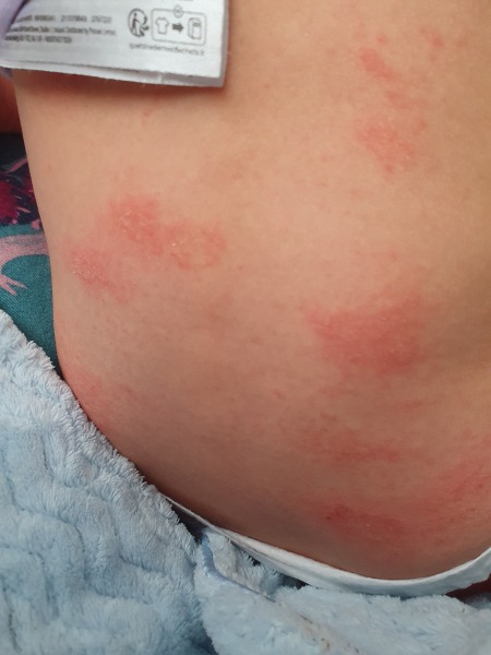 Does this look like hives?