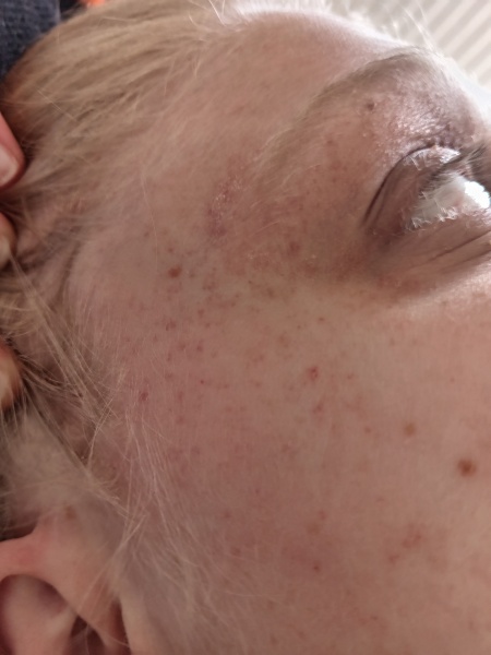 What the heck is this awful rash