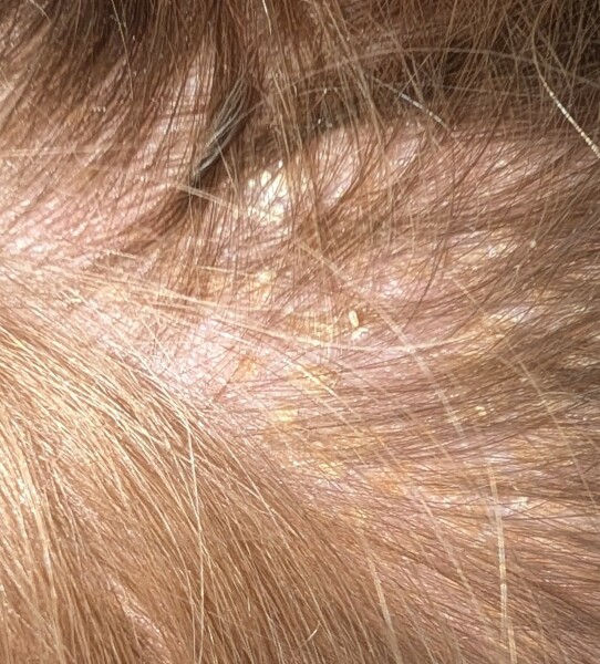 Is this scalp psoriasis (picture included)