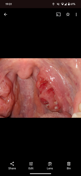 Beware graphic photo, how can my tonsil be this bad but not really be very painful?!