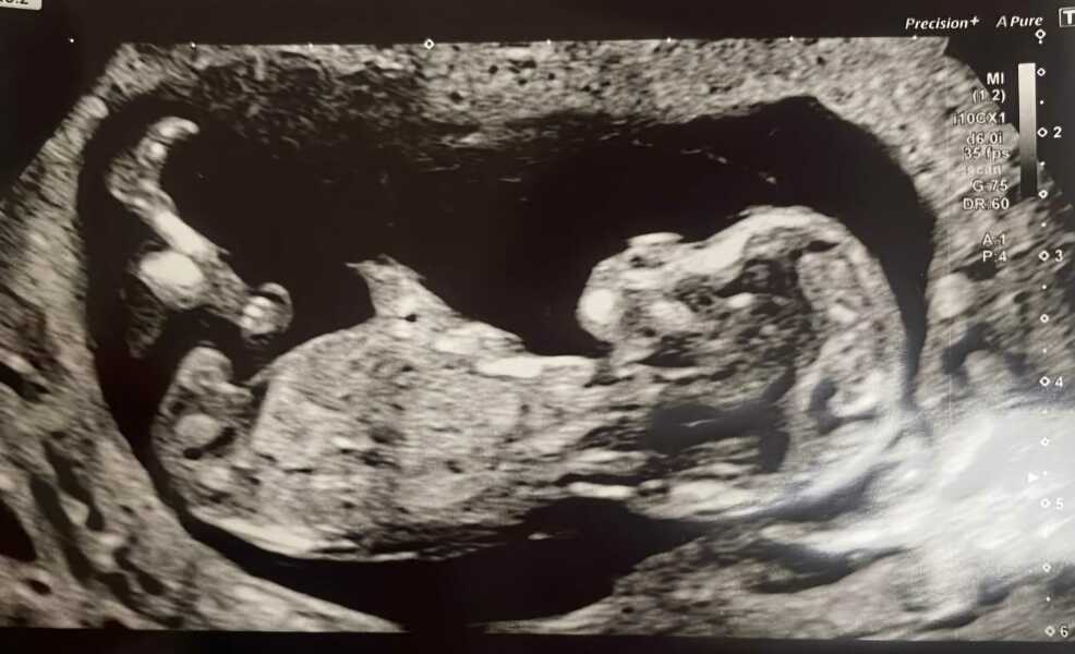 12 week scan nub/skull theory