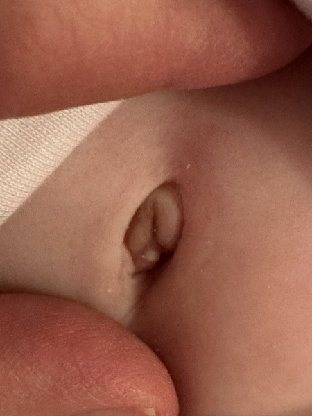 Whitehead on belly button