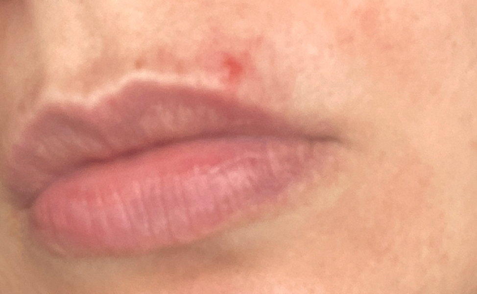 Is this a coldsore?