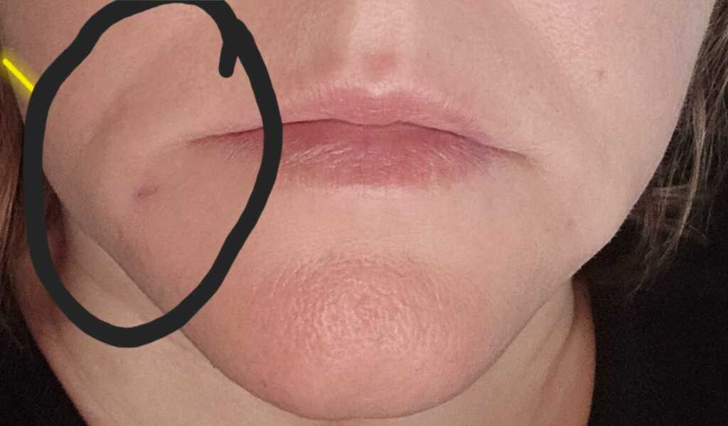 Had filler yesterday...