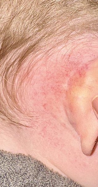 Weird rash behind both ears