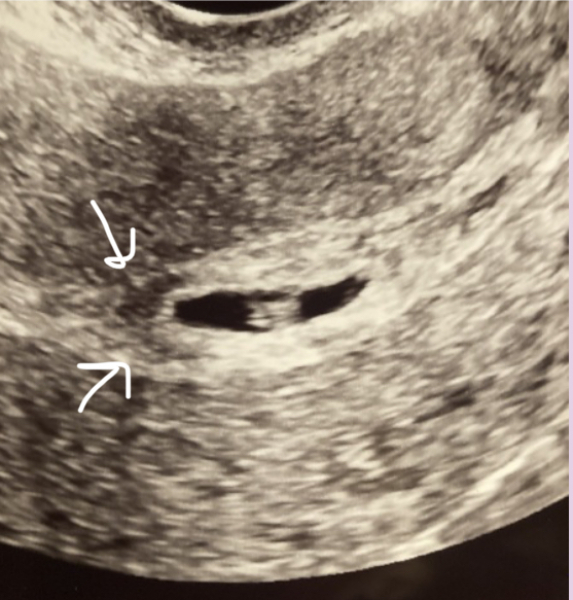 Subchorionic Hematoma