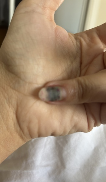 Skin cancer or fungal infection?