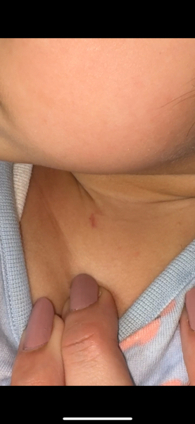 What could this mark be on my one year old?