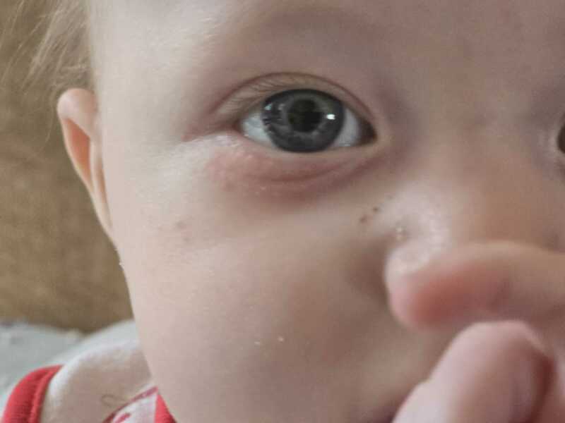 Worried about a rash?