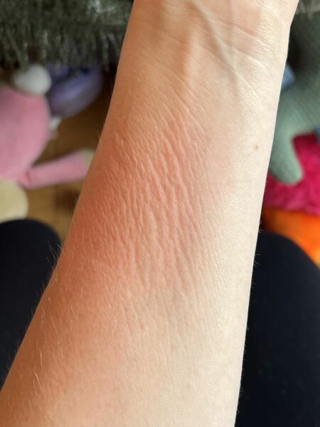 Skin condition