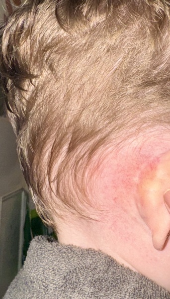 Weird rash behind both ears