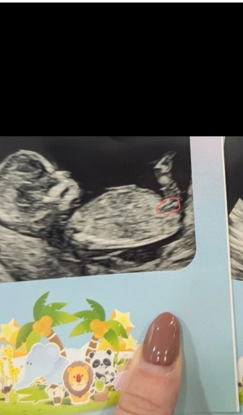 Girl or boy? I don't really understand nub/skull theories