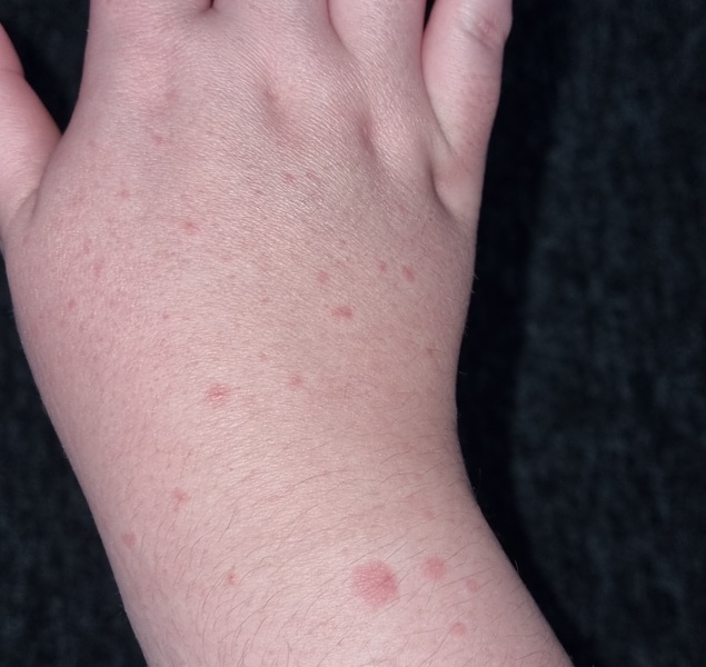 Rash on back of hands- Adult