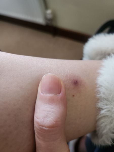 Does this look like a tick bite?