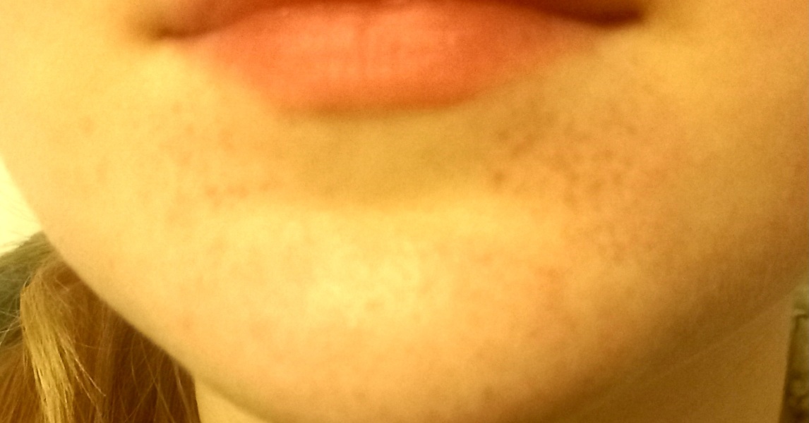 Sudden pinprick rash