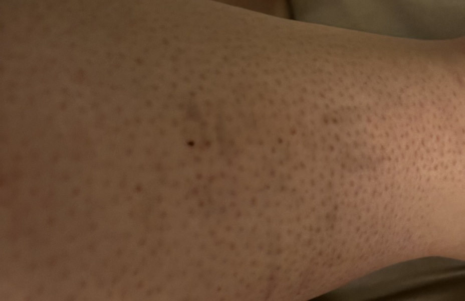 To be worried about these new marks on my calf? Photo
