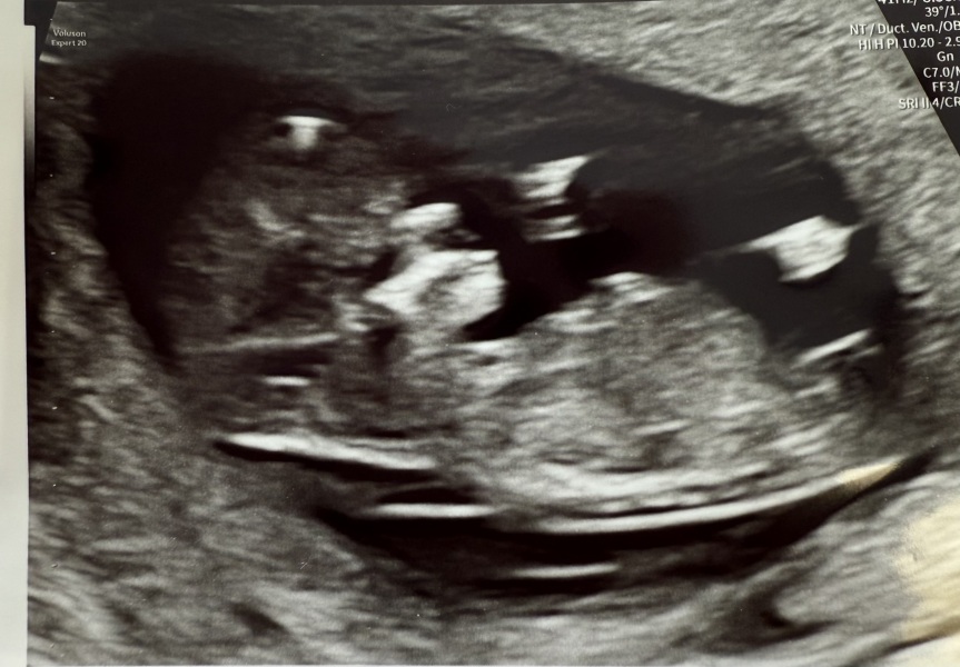 Nub theory- boy or girl?
