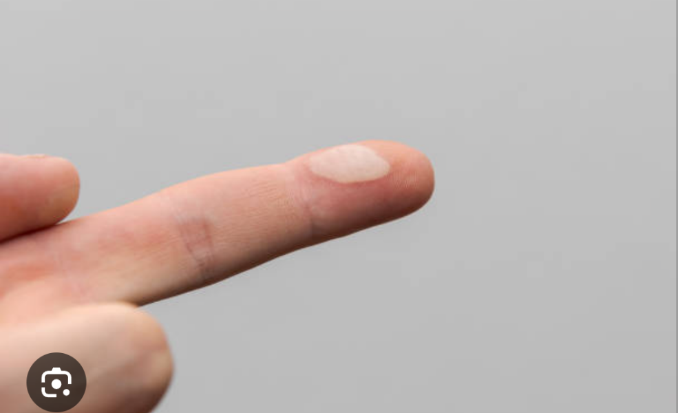 Toddler burnt her fingertips on stovetop! Recovery questions