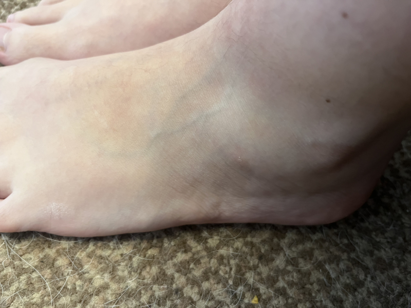 Hurt ankle/foot- do I just rest it?