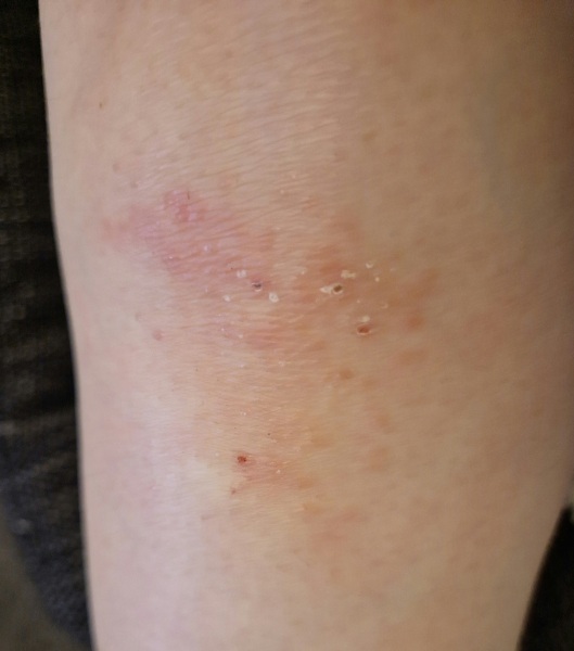 What is this rash?