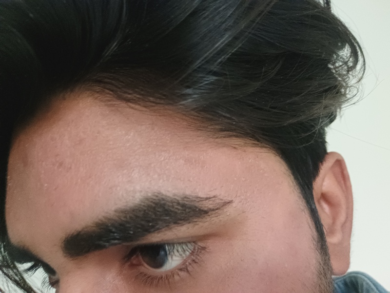 Dandruff and dry scalp