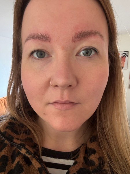 Help with facial asymmetry! Botox? Fillers? Anything?