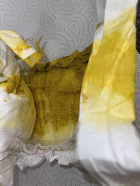 Is this normal baby nappy 🤔 [contains photo]