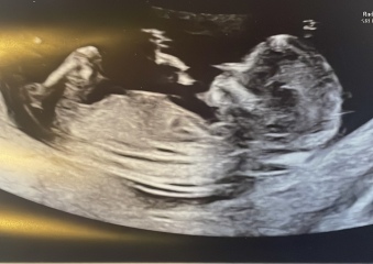 Nub? Is there no nub? Anyone got any guesses