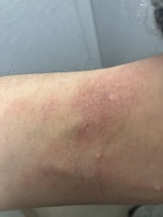 Psoriasis or eczema