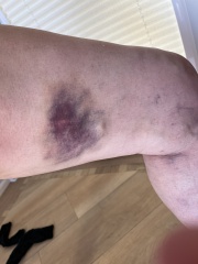 Large black bruise getting worse