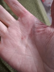 Hand infected (Warning, gross photos)