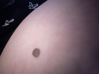 Mole getting bigger