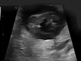 Gender scan at 15 weeks and 3 days
