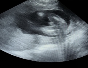 Boy or girl? 17w