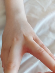 Is this scabies or something else?