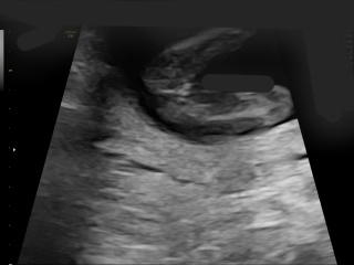 Gender scan at 15 weeks and 3 days