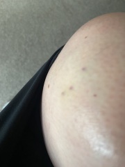 Spots on knee