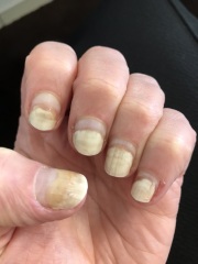 Badly damaged nails (photos)- please help!