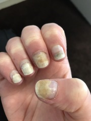 Badly damaged nails (photos)- please help!