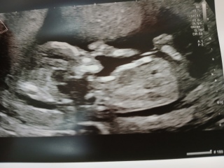 Nub/skull theory at 14 weeks