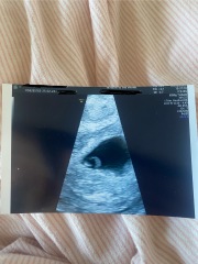 No growth between scans?