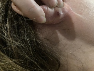 Popped large sebaceous cyst